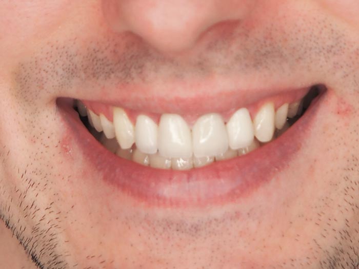 Kompleksowa zmiana wyglądu zębów​ - Po