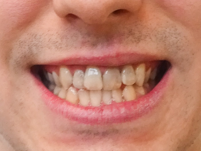 Kompleksowa zmiana wyglądu zębów​ - Przed